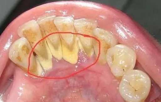 怎么去除牙结石（需就医进行专业洁治）